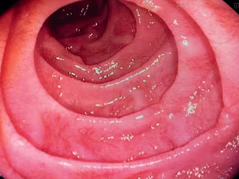 Coeliac disease