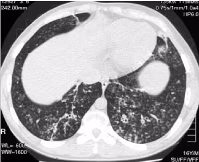 Diffuse panbronchiolitis
