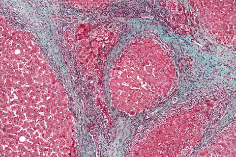 Hepatorenal syndrome