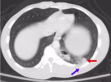 Pulmonary contusion